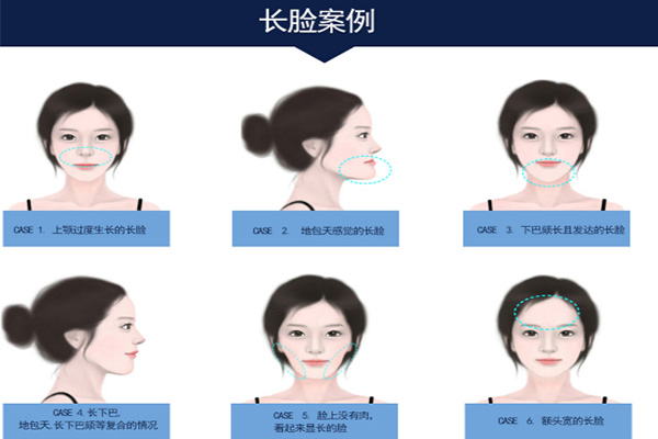 韩国菲斯莱茵长脸案例.jpg