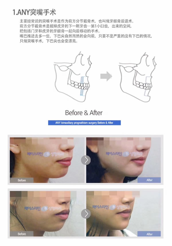 什么是韩国菲斯莱茵any突嘴手术.jpg
