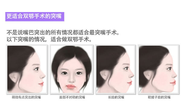 更适合做双颚手术的突嘴情况分为哪几类.jpg