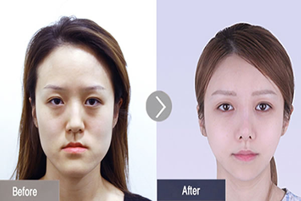 韩国菲斯莱茵SMART额头缩小术案例对比图.jpg