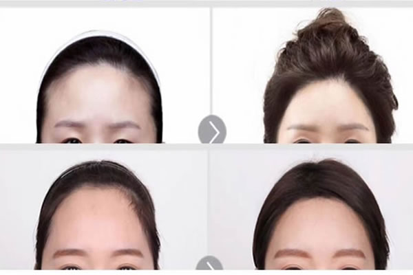 韩国菲斯莱茵SMART额头缩小术案例图片.jpg