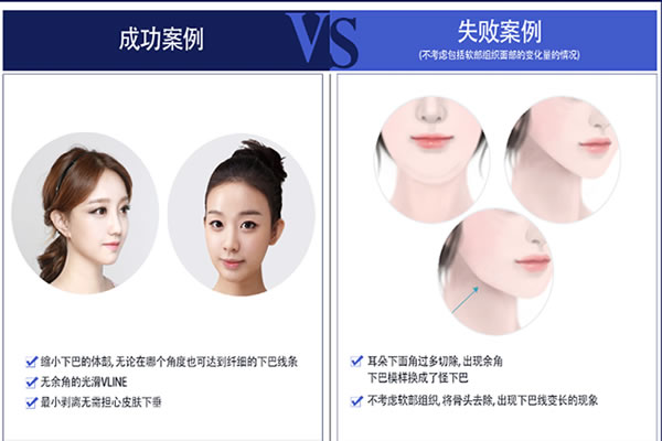韩国菲斯莱茵Vline雕刻效果对比图.jpg
