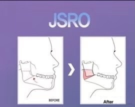 JSRO双颚手术设计图.jpg