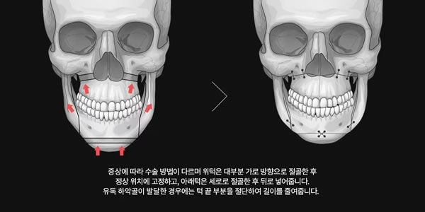 改善长脸的双鄂手术（面中长）设计图.jpg