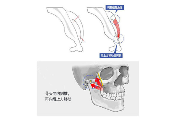 韩国菲斯莱茵颧骨缩小术方法.jpg