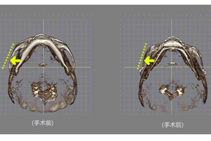 颧骨整形前后对比图.jpg
