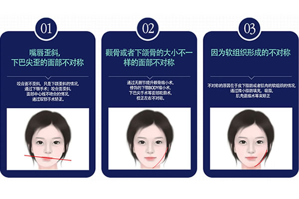 韩国菲斯莱茵面部不对称手术方法.jpg