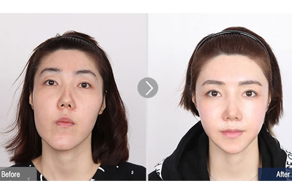 韩国菲斯莱茵面部不对称案例对比图.jpg