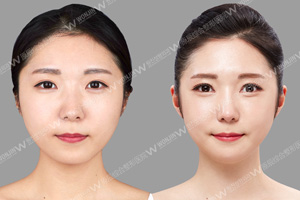 鼻翼缩小案例对比.jpg