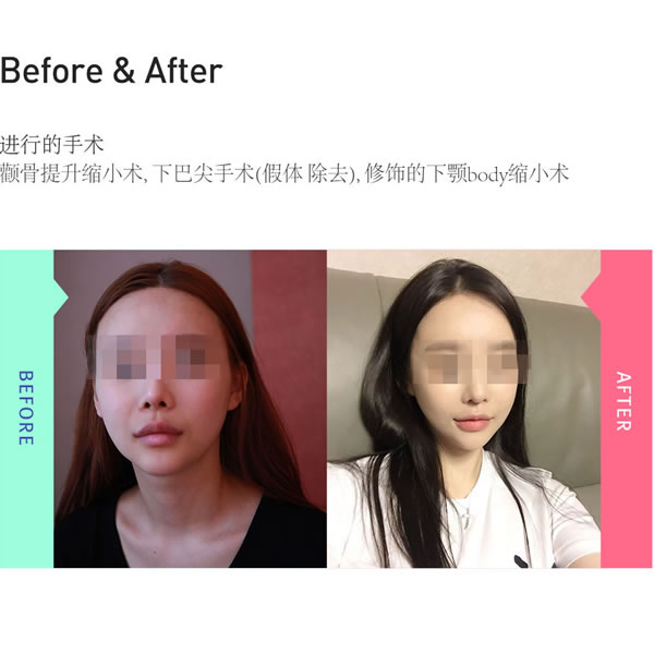 韩国菲斯莱茵整形医院颧骨缩小手术前后对比案例.jpg