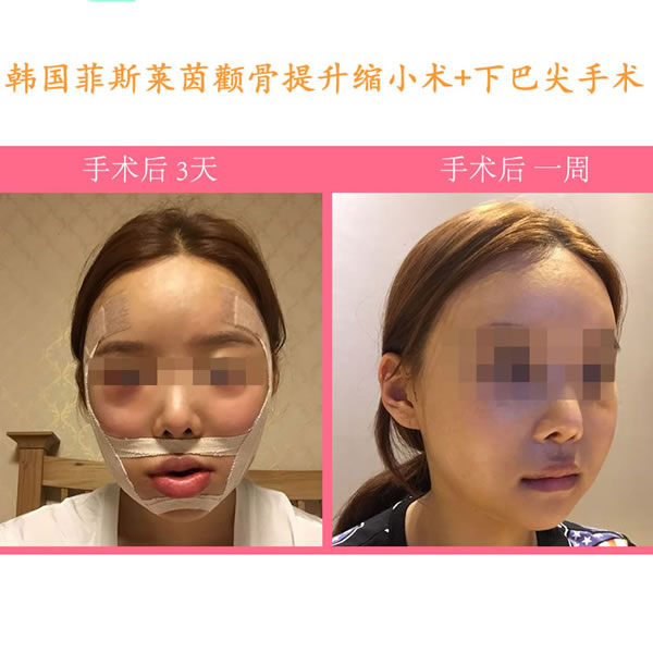 韩国菲斯莱茵整形医院颧骨缩小手术一周左右图片jpg