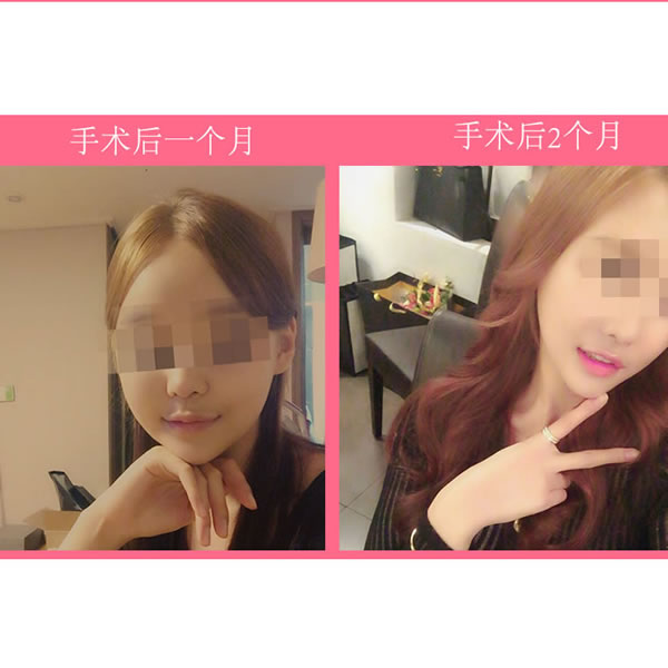 韩国菲斯莱茵整形医院颧骨缩小手术一二个月图.jpg