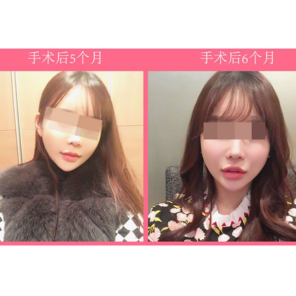 韩国菲斯莱茵整形医院颧骨缩小手术五个月左右图.jpg