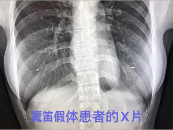 魔笛假体X光片.jpg