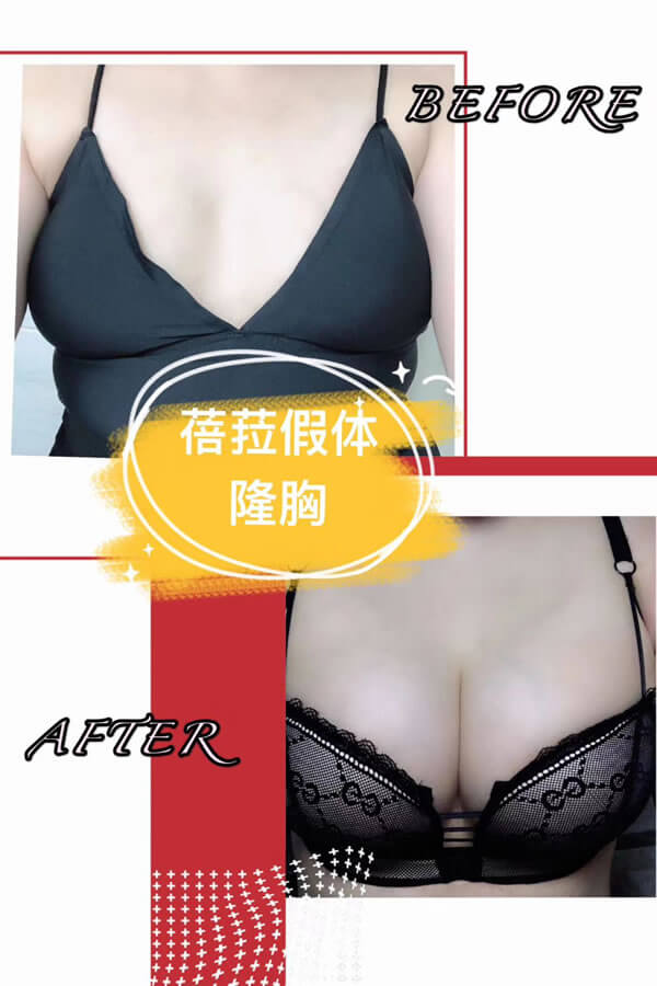 贝拉假体真人术后效果案例.jpg