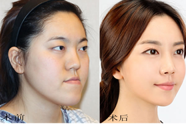 韩国菲斯莱茵鞋拔子脸手术案例.jpg