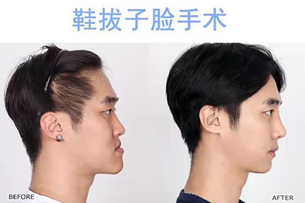 韩国菲斯莱茵鞋拔子脸手术案例对比图.jpg