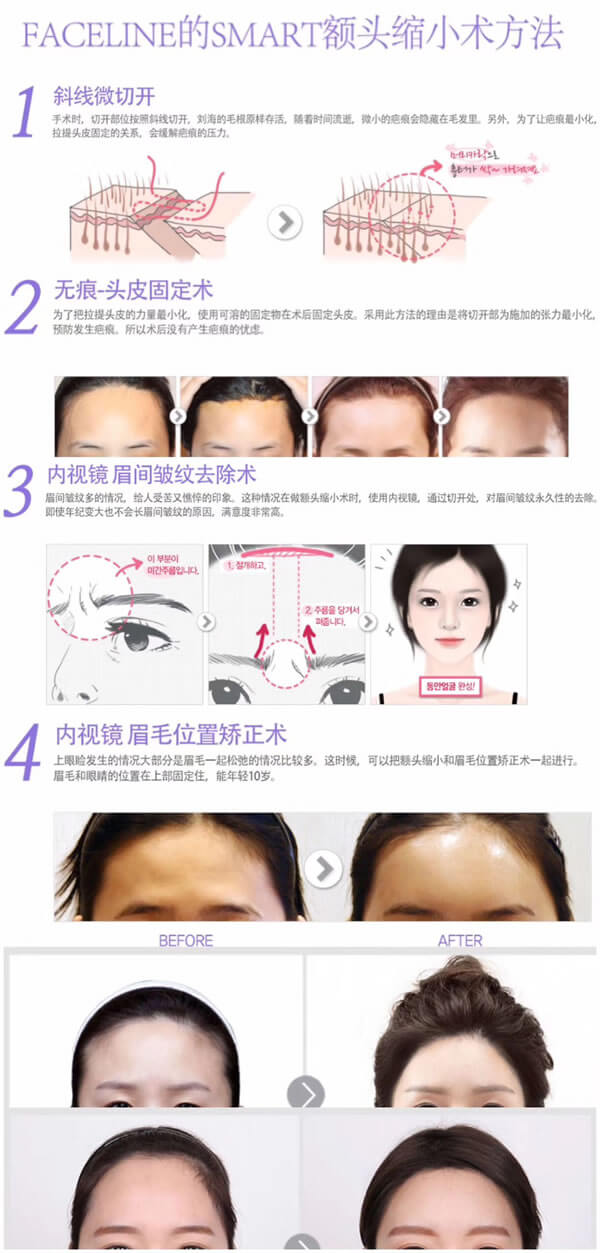菲斯莱茵无痕额头缩小手术方法.jpg