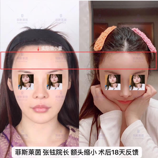 菲斯莱茵张铉院长额头缩小术后18天反馈照片.jpg