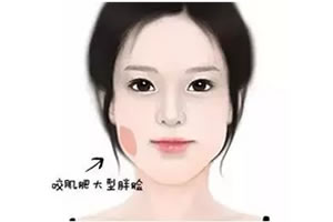 咬肌肥大的情况.jpg