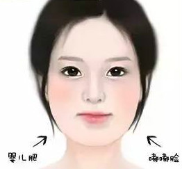 脂肪堆积造成下颌角肥大.jpg