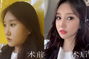 韩国菲斯莱茵下颌角缩小术案例对比图.jpg