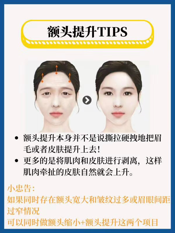 内窥镜提升额头手术建议.jpg