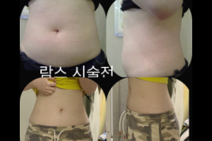 365腰腹吸脂案例