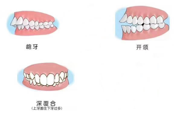 造成凸嘴手术的原因.jpg