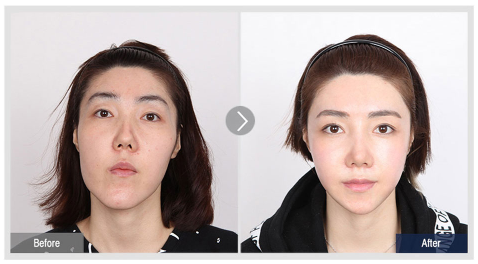 双鄂手术前后对比.png