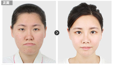 双鄂手术前后对比.png