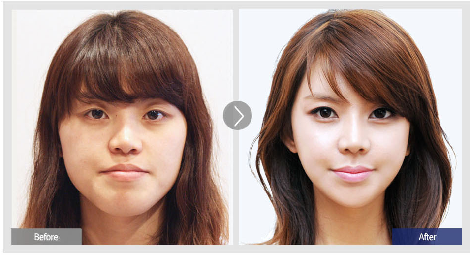 双鄂手术前后对比.png