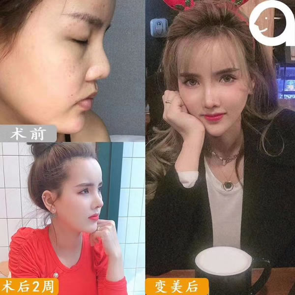 MESH假体材料前后对比案例.jpg