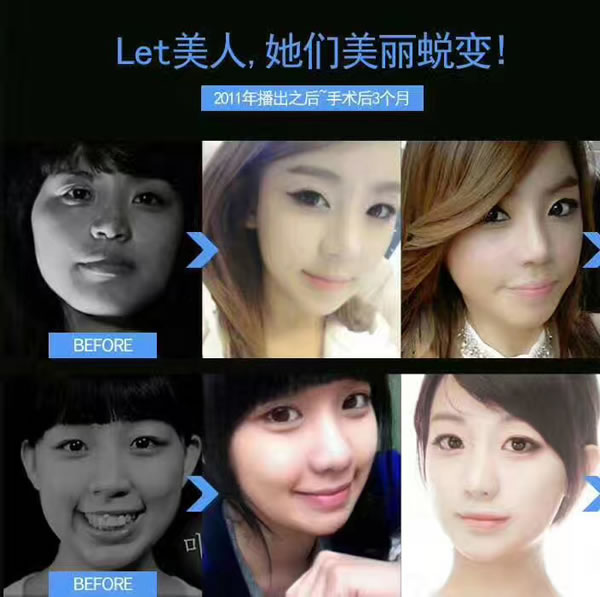 凸嘴手术整形前后对比案例.jpg
