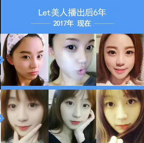凸嘴手术整形案例jpg