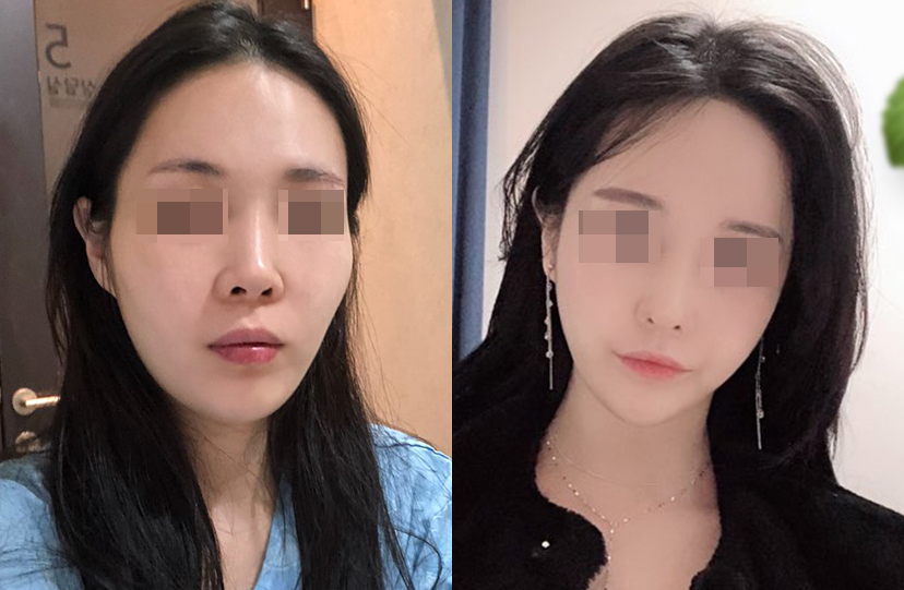 faceline颧骨手术对比.png
