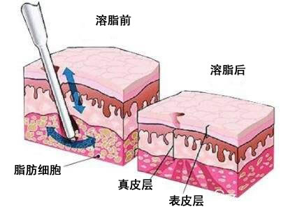 溶脂针瘦脸的效果.jpg