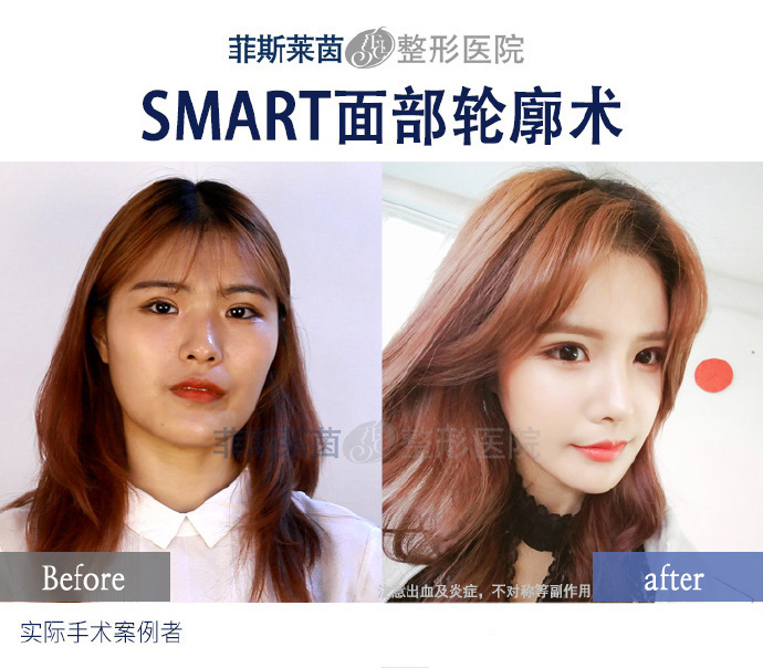面部轮廓手术瘦脸前后变化.jpg
