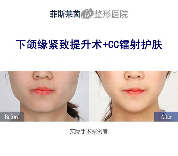 菲斯莱茵整形医院下颌缘提升前后对比效果.jpg