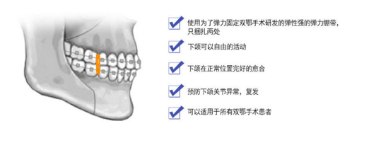 弹力固定方式.png