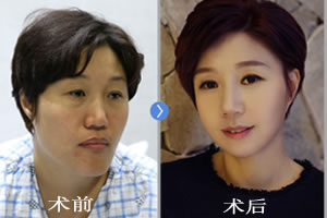 韩国菲斯莱茵抗老化童颜轮廓术案例.jpg