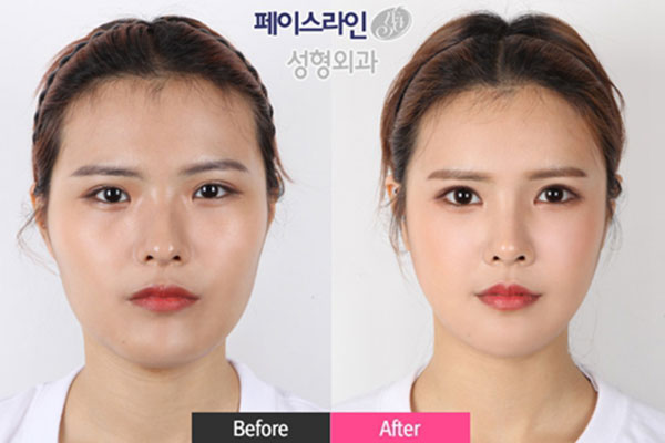 韩国菲斯莱茵Face-line整形医院整形案例