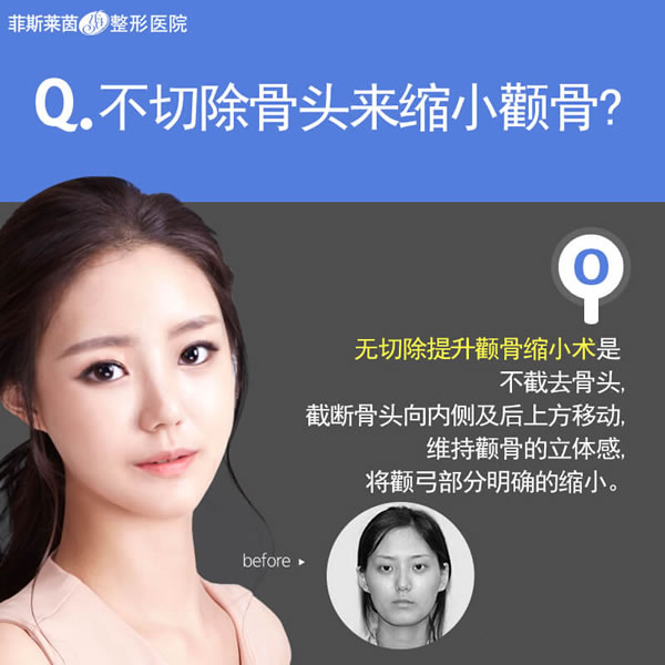 菲斯莱茵无删除颧骨缩小提升术.jpg