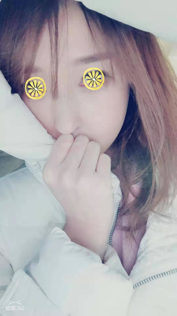 在菲斯莱茵做完颧骨术后一个月的样子.jpg