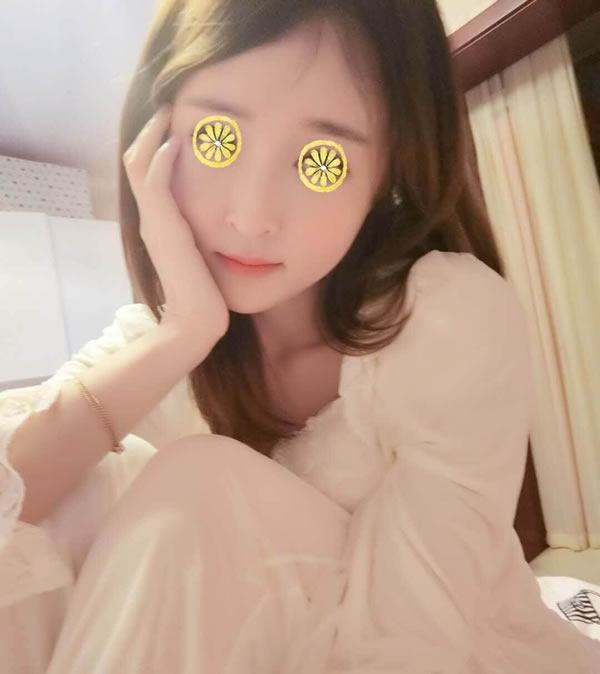 在菲斯莱茵做完无删除颧骨缩小提升术后六个月的样子.jpg