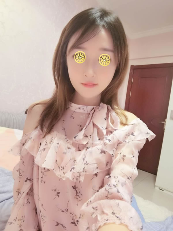 在菲斯莱茵做完颧骨术后六个月的样子.jpg