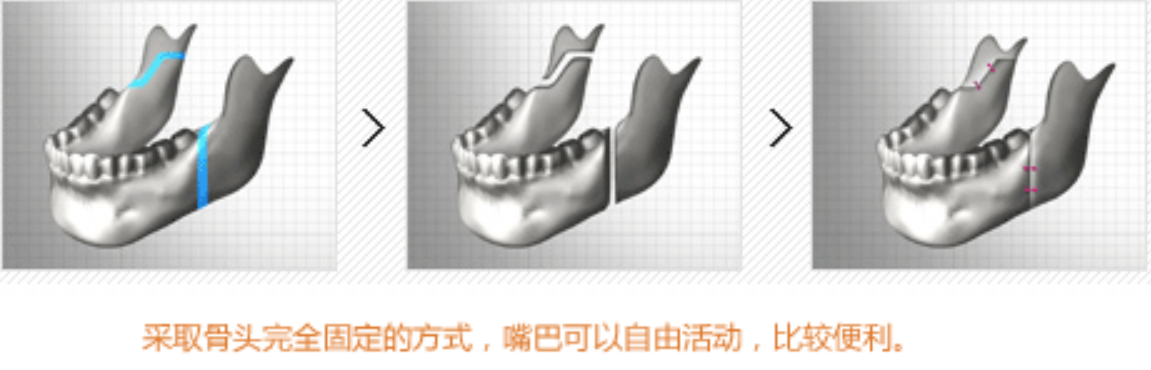 下颌支矢状骨劈开术【SSRO】