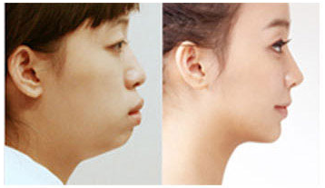 突嘴前后对比.png