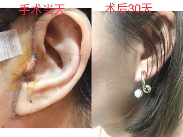 菲斯莱茵李英才院长迷你拉皮术后一个月恢复照.jpg