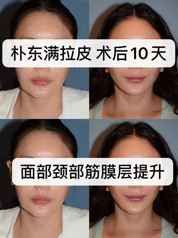 韩国bio整形医院朴东满拉皮术后恢复案例.jpg